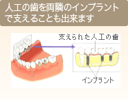 人工の歯を両隣のインプラントで支えることもできます