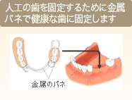 人工の歯を固定するために金属バネで健康な歯に固定します