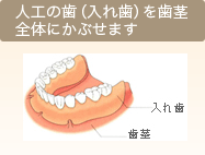 人工の歯（入れ歯）を歯茎全体にかぶせます